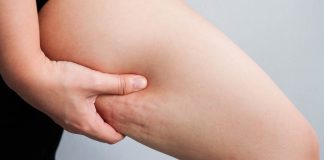 3 remedii naturiste pentru eliminarea celulitei